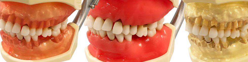 Choosing the Right Replacement Gingiva for your Nissin / Kilgore Typodont
