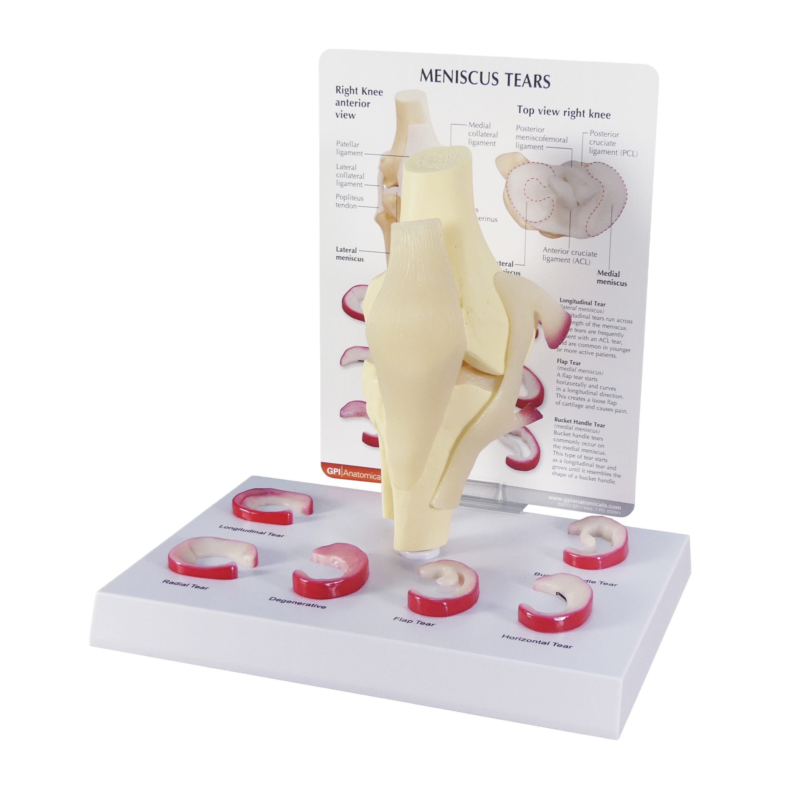 Meniscus Tears (6 Tears)