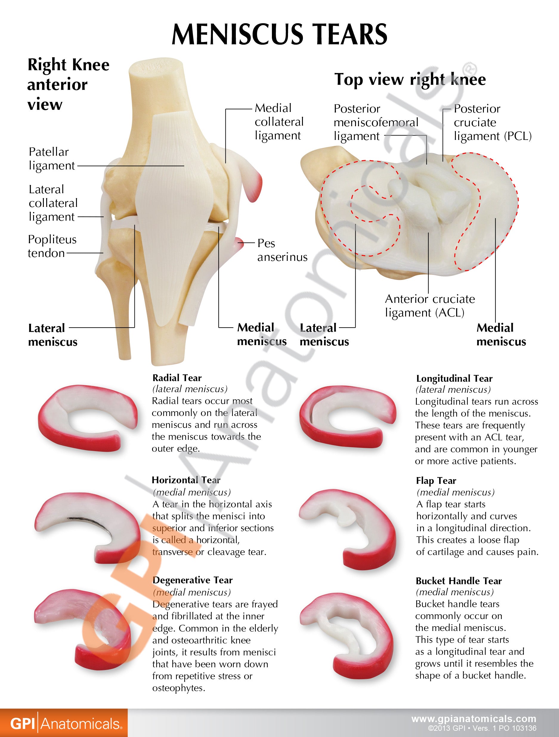 Meniscus Tears (6 Tears)
