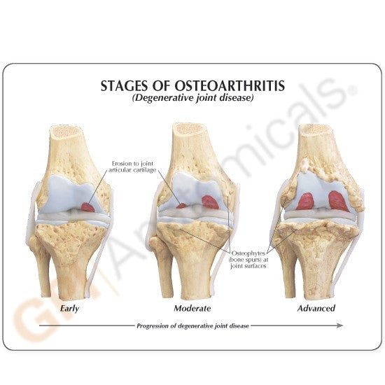 1100-stages-of-arthritis__73315.1589753331.1280.1280.jpg