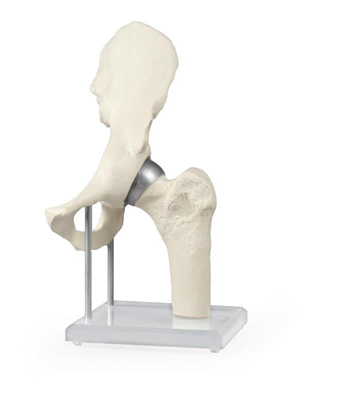 Hip joint with resurfacing implant - Erler Zimmer 1118