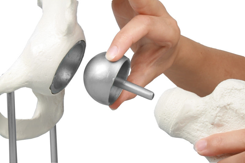 Hip joint with resurfacing implant - closeup - Erler Zimmer 1118