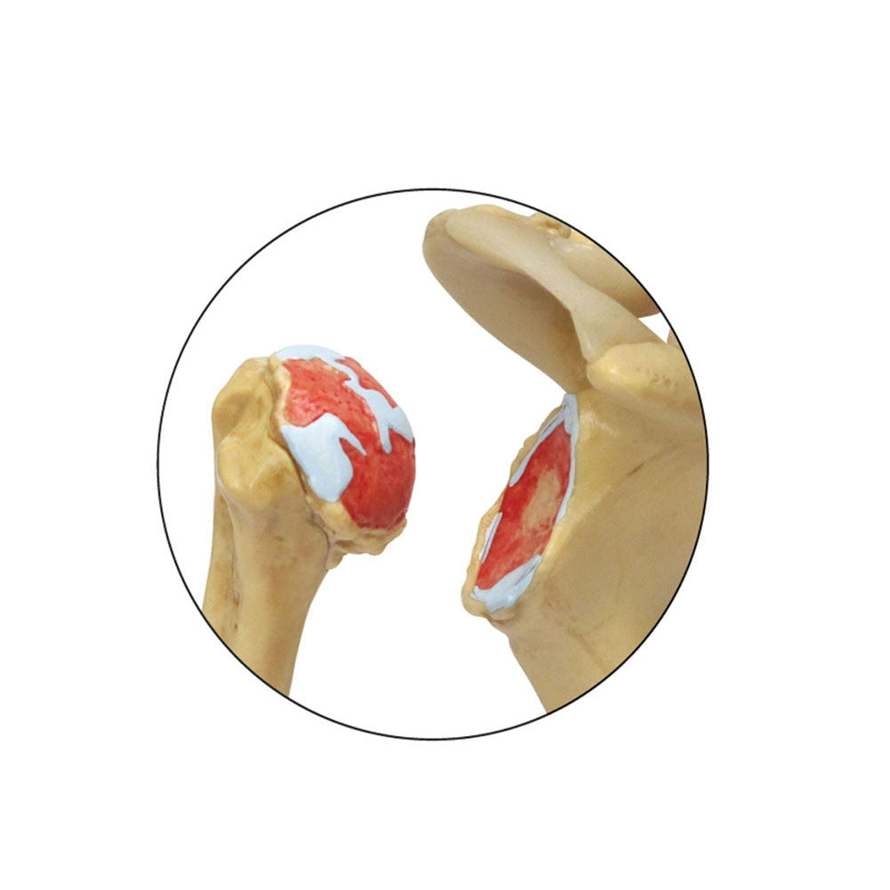 1800_4st_osteoarthritis_shoulder_-ins__59363.1589753069.1280.1280.jpg