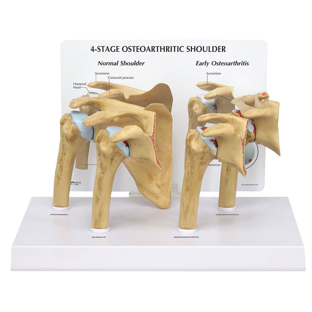 1800_4st_osteoarthritis_shoulder__12670.1589753069.1280.1280.jpg
