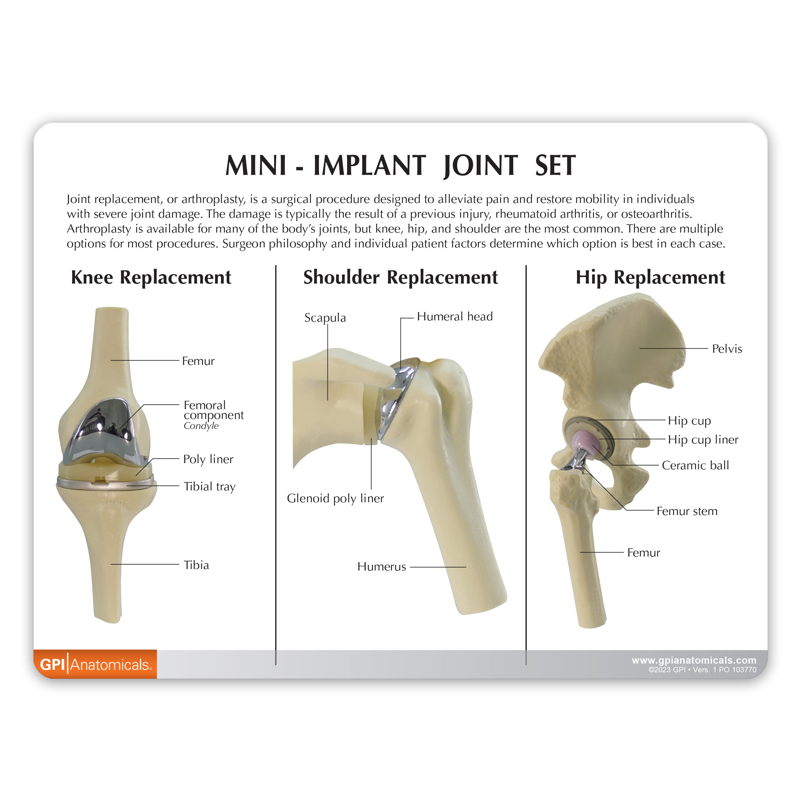 Mini-Implant Joint Set (NEW! Model)