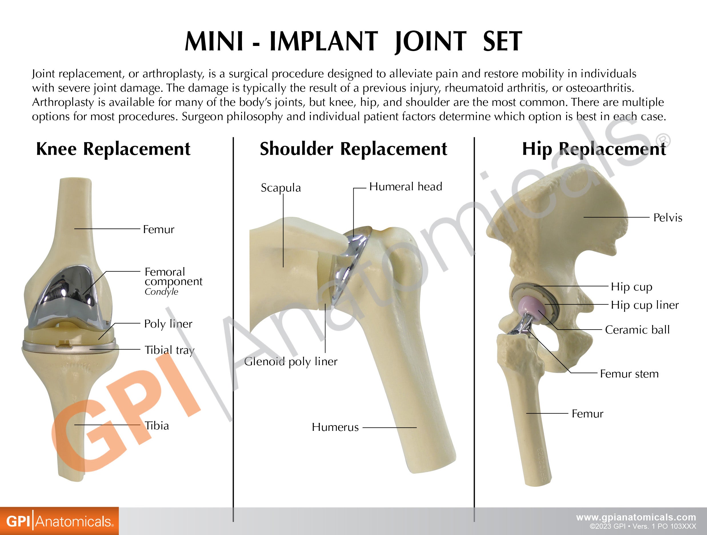 Mini-Implant Joint Set (NEW! Model)