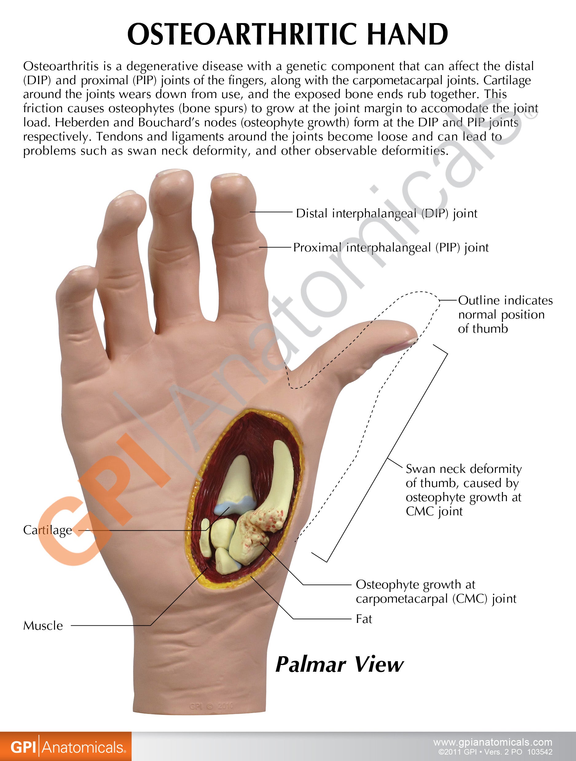 Osteoarthritis (OA) Hand