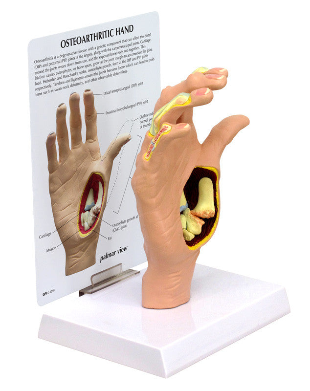 1930_osteoarthritis-oa-hand__57155.1589753322.1280.1280.jpg