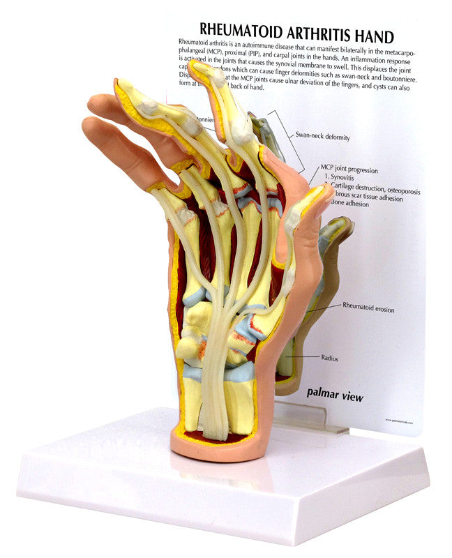 1931_rheumatoid-arthritis-r__21591.1589752906.1280.1280.jpg