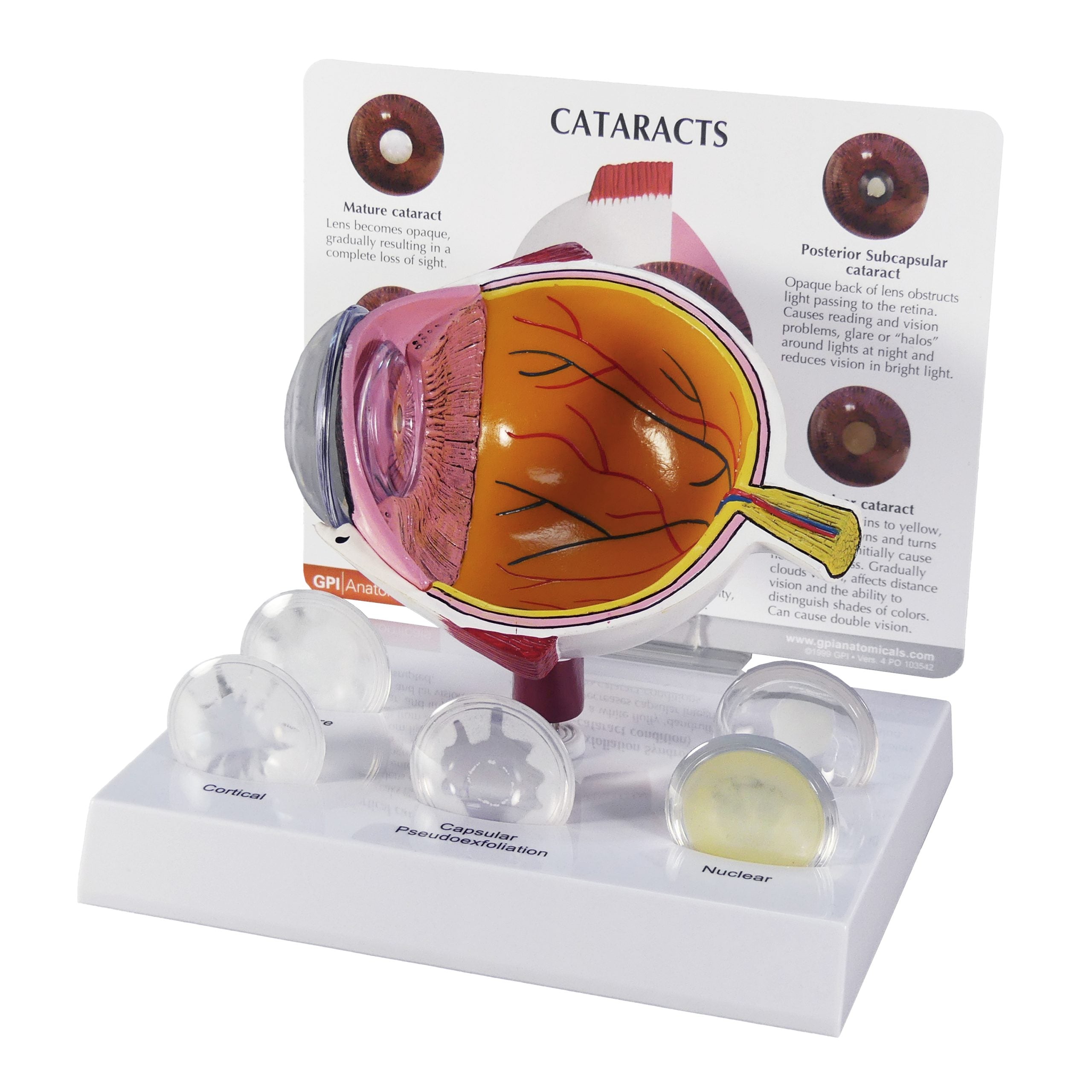 Cataract Eye (cut-away)