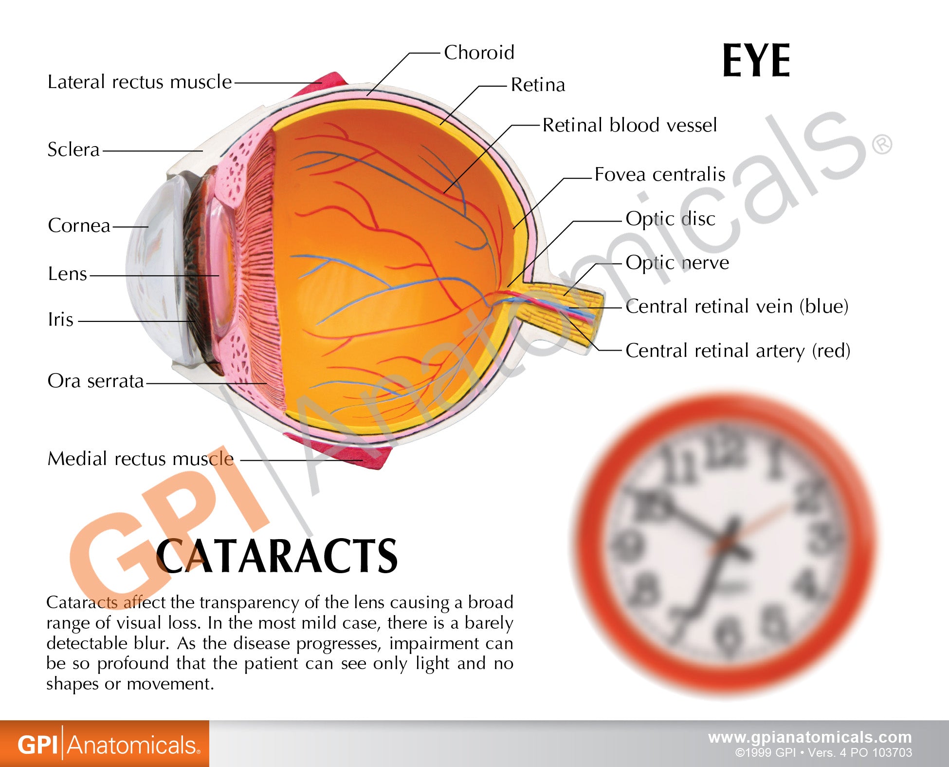 Cataract Eye (cut-away)