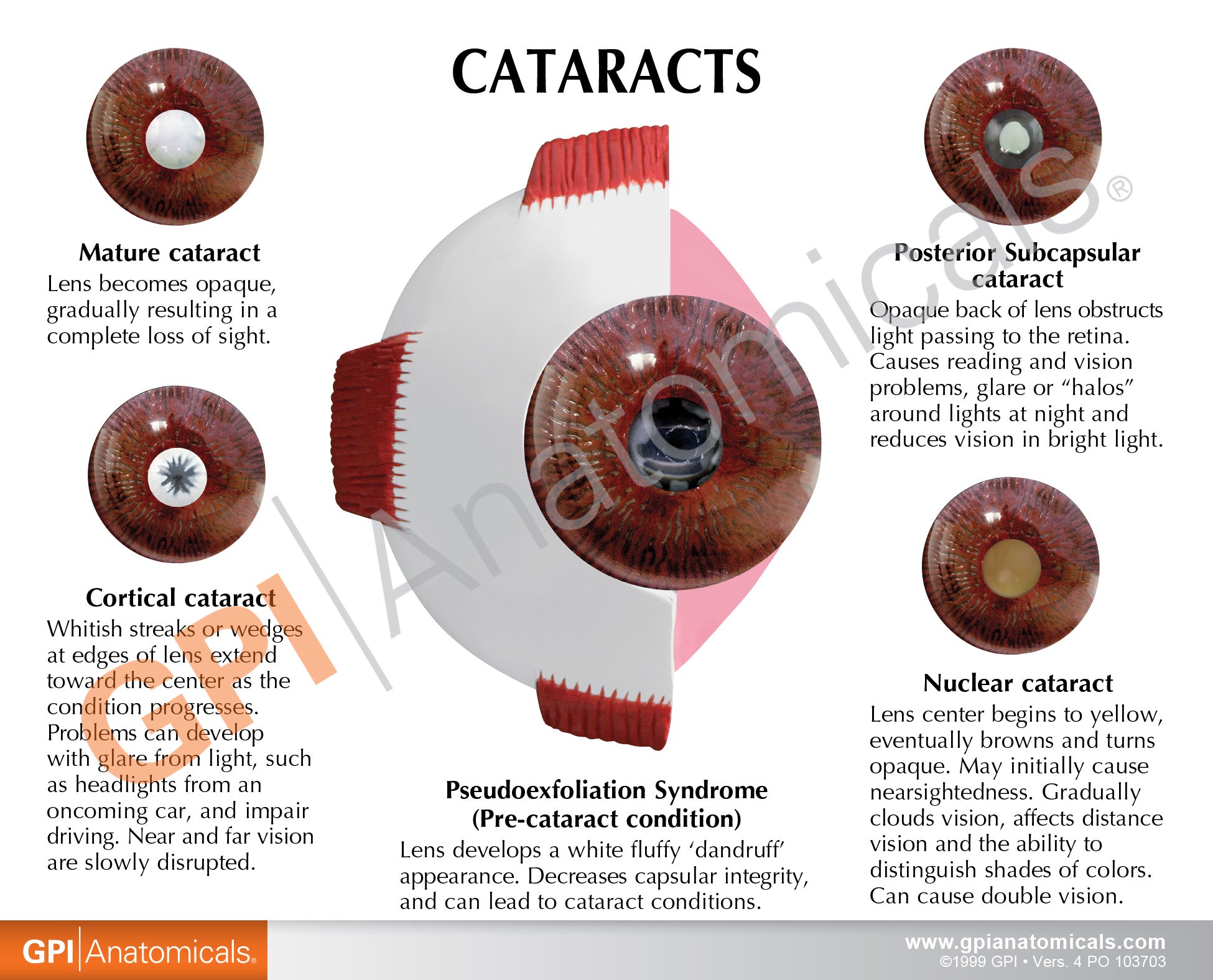 Cataract Eye (cut-away)