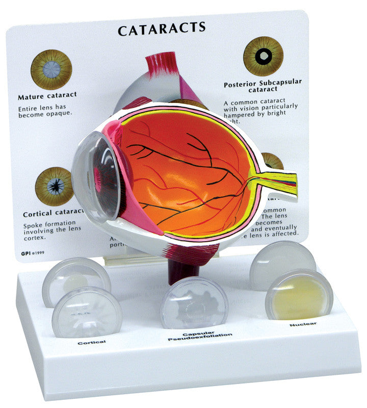 2800_cataract__47122.1589753298.1280.1280.jpg
