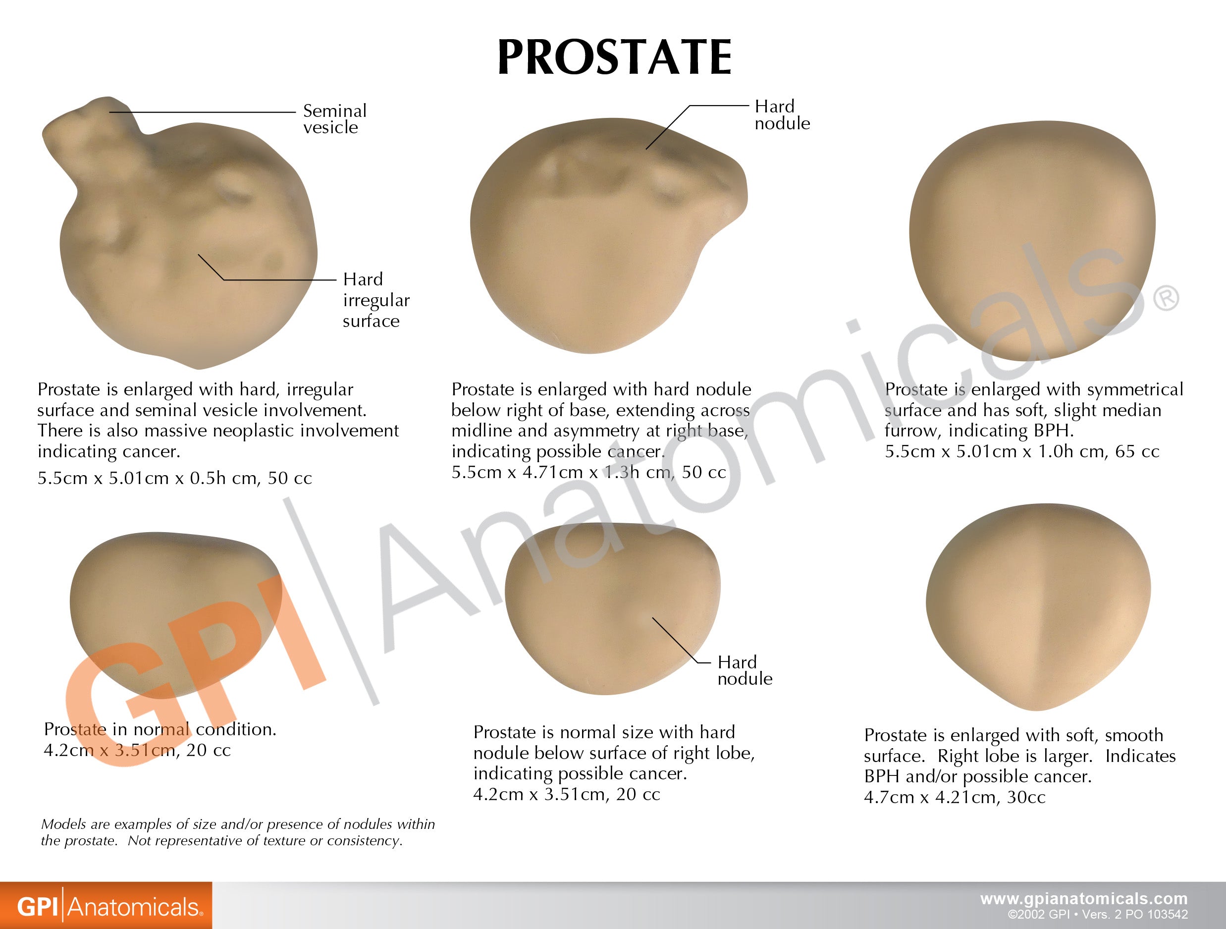 Prostate model set