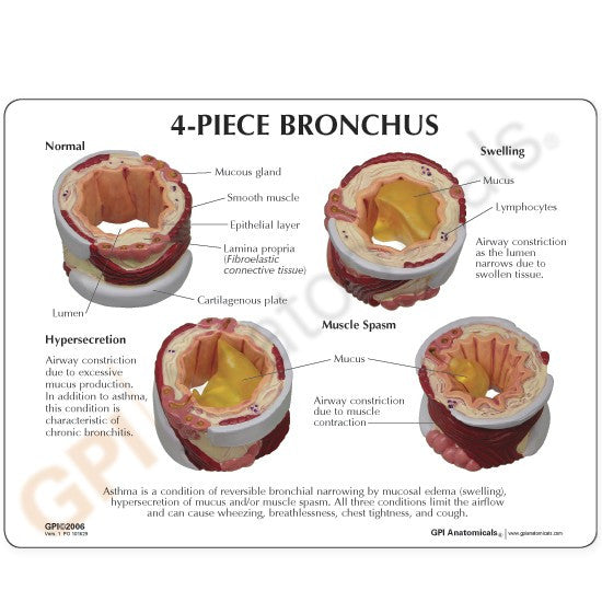 3120-bronchus__04352.1642350016.1280.1280.jpg