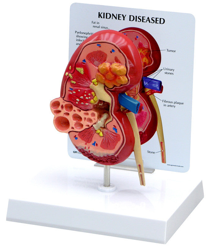 3260_kidney_pathology__40801.1589752937.1280.1280.jpg