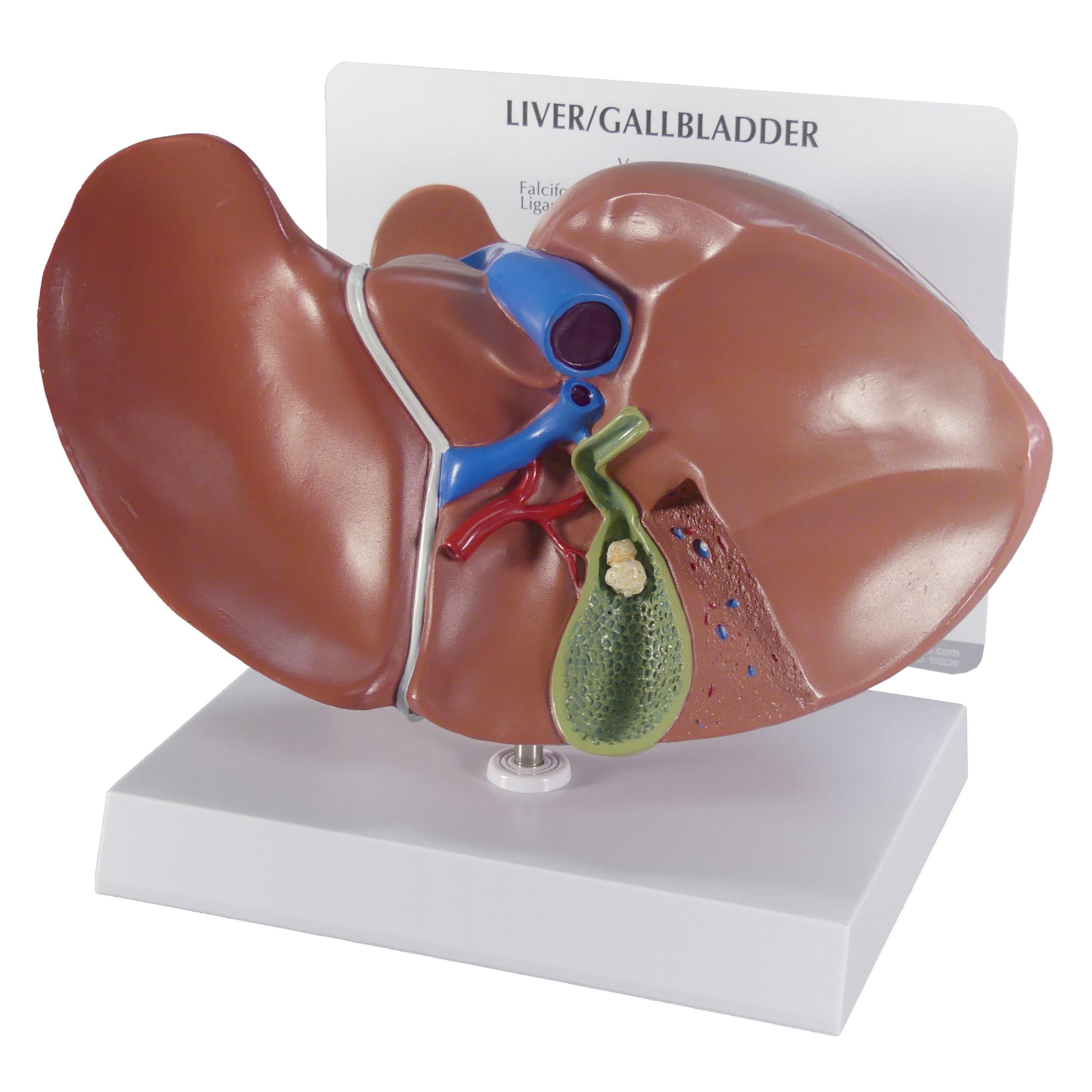 Liver/Gallbladder (with Gallstones)