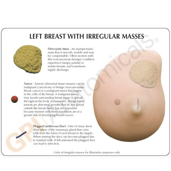 3401-breast-cancer-rear__93746.1589753056.1280.1280.jpg
