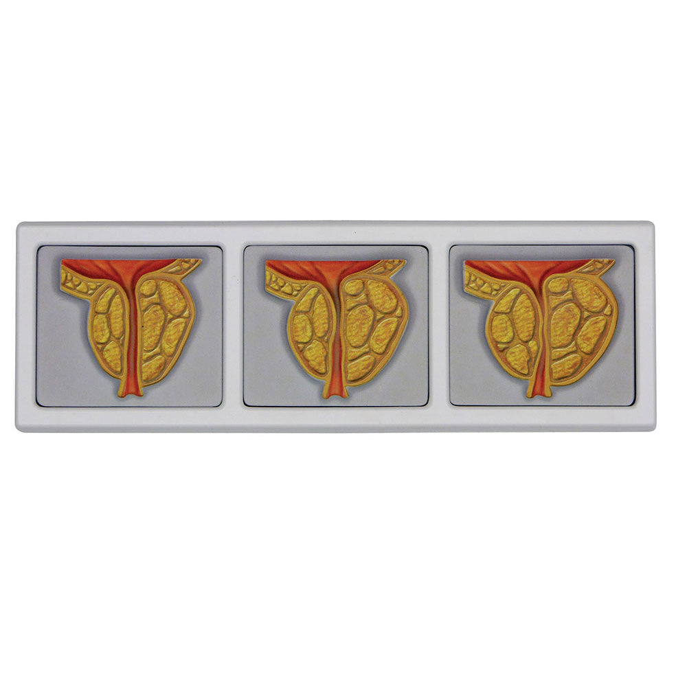 3551_pelvis_prostate_det__33859.1589753167.1280.1280.jpg
