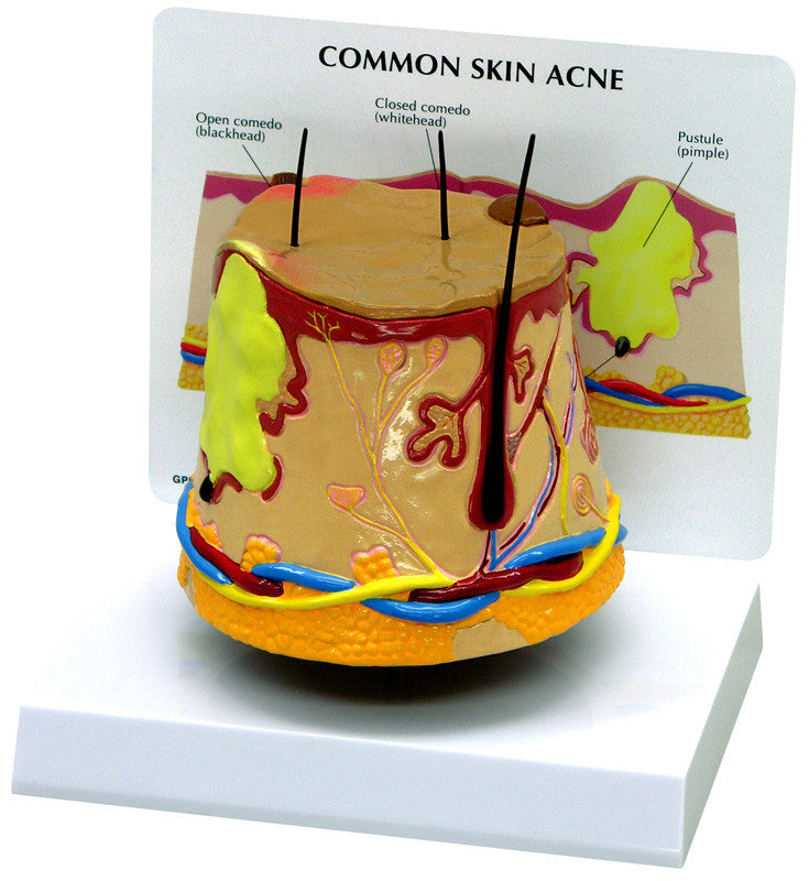 3750_skin_acne__53828.1589753230.1280.1280.jpg