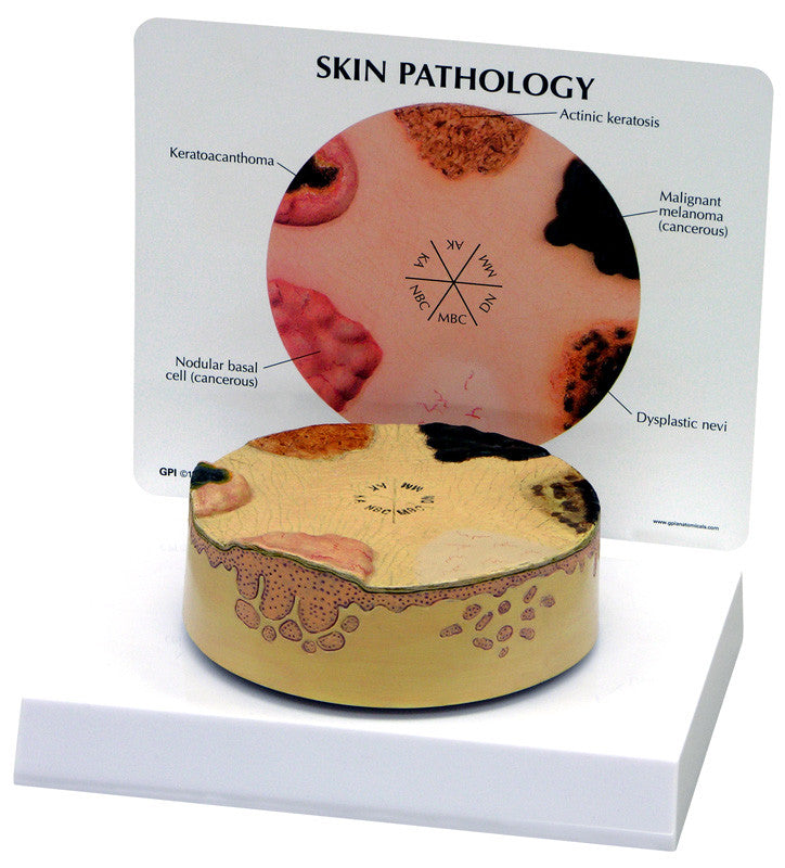 3850_skin_cancer__59578.1589752960.1280.1280.jpg