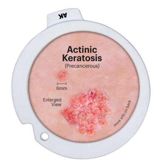 Precancerous & Cancerous Skin Lesions Hinged Disk Set