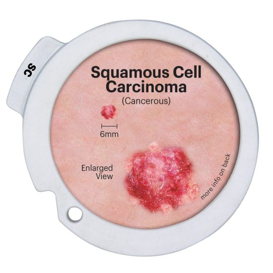 Precancerous & Cancerous Skin Lesions Hinged Disk Set