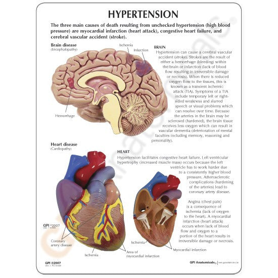 4000-hypertension-rear__20114.1589753215.1280.1280.jpg