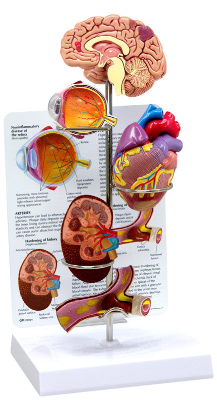 4000_hypertension__48987.1589753215.1280.1280.jpg