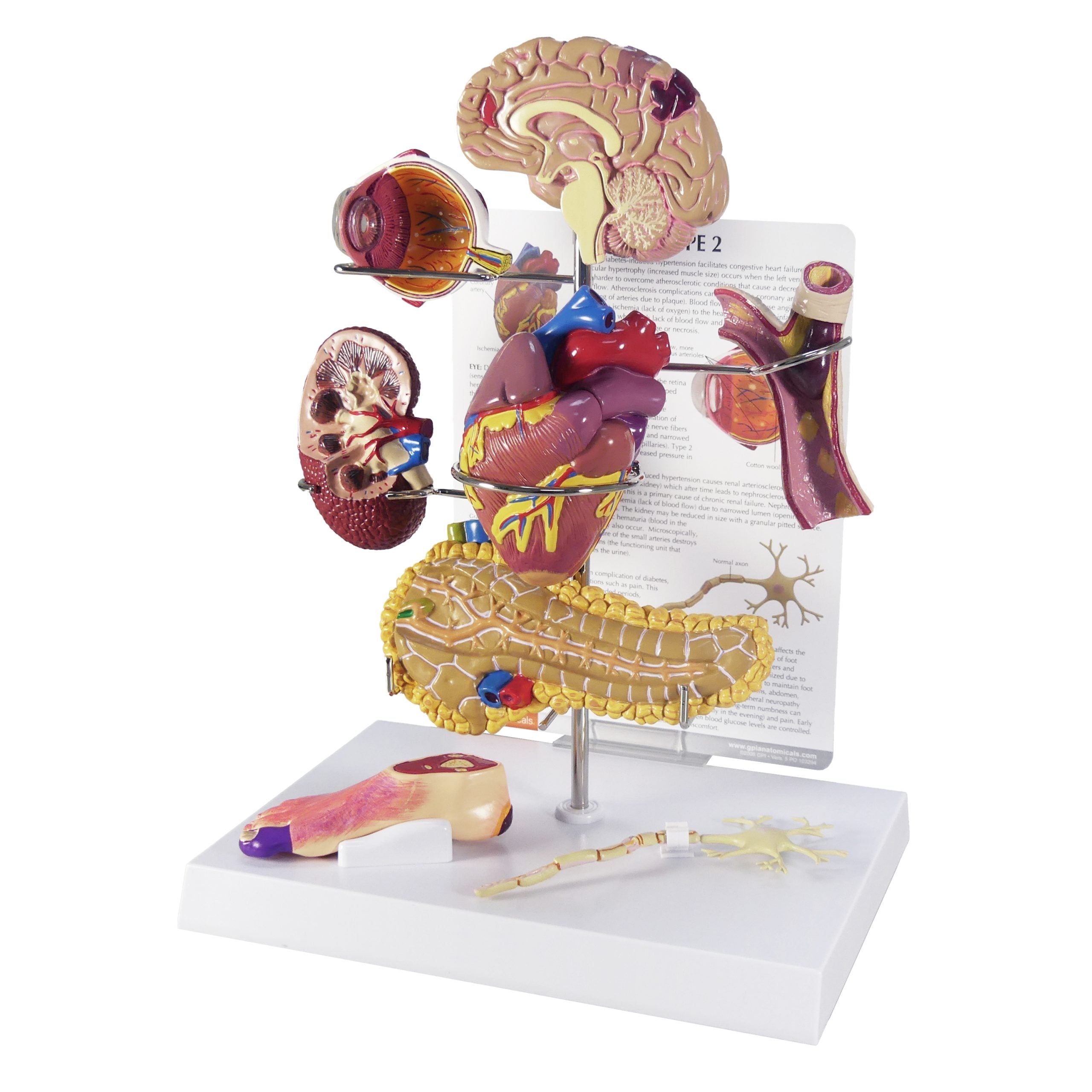 Type II Diabetes Set Model