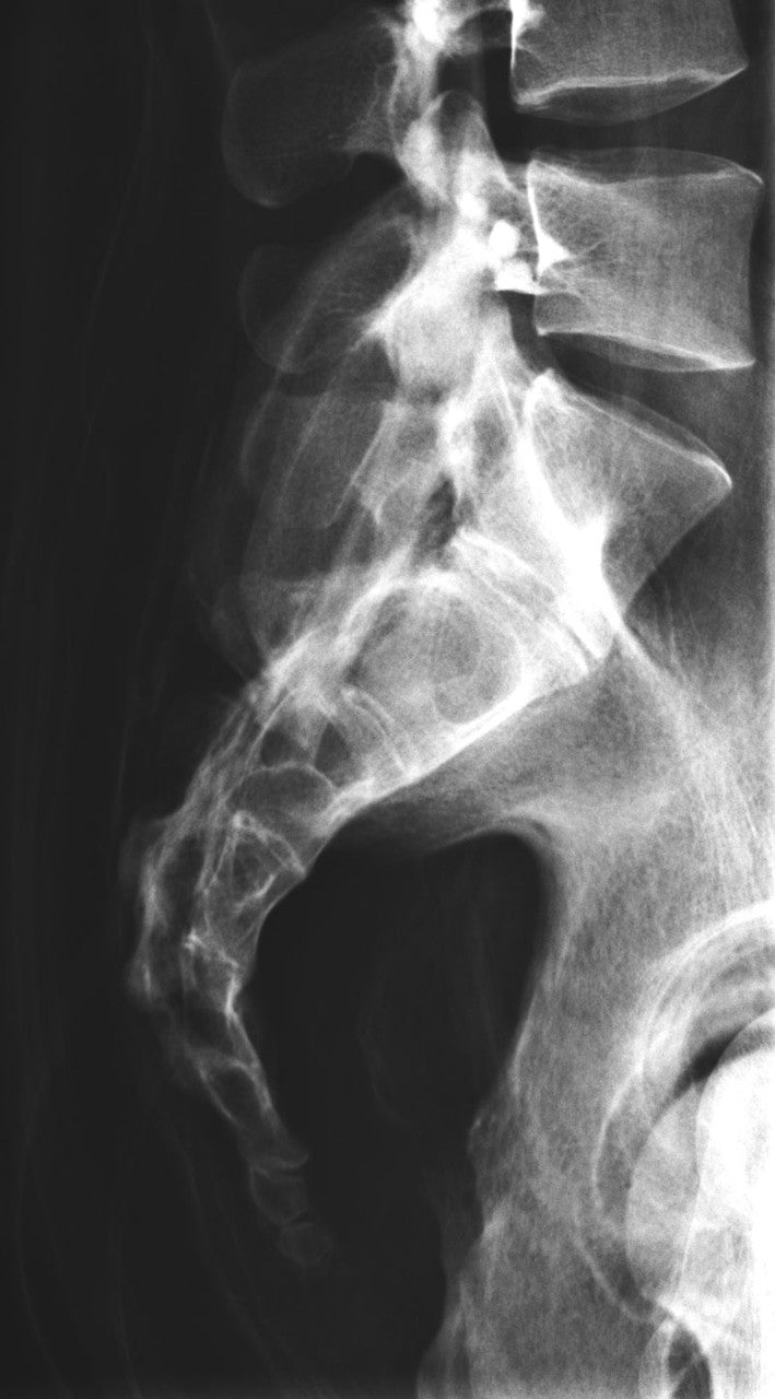 Full Body X-Ray Phantom - Sacrum