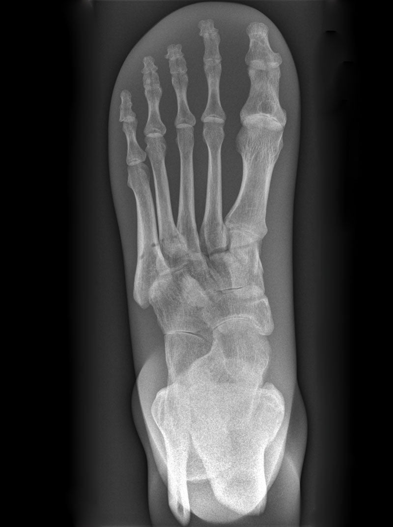 X-Ray Phantom Foot, opaque