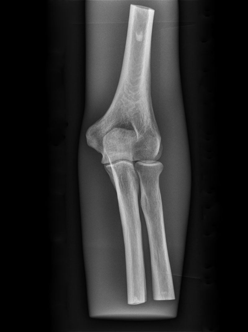X-Ray Phantom Elbow, transparent