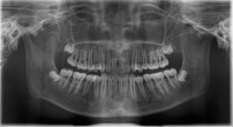 X-ray phantom head, transparent