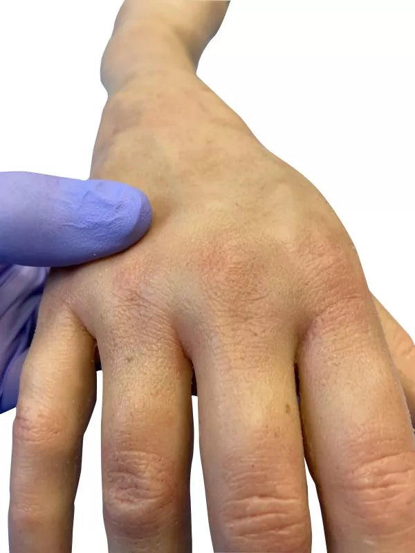 Puncture Pete – hyperrealistic IV training arm, light skin color