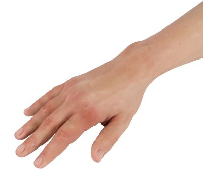 Puncture Pete – hyperrealistic IV training arm, light skin color