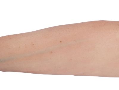 Puncture Pete – hyperrealistic IV training arm, light skin color