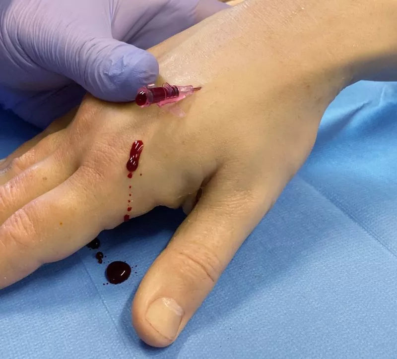 Puncture Pete – hyperrealistic IV training arm, light skin color