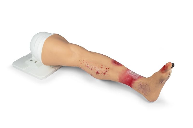 "Lena Leg" - Leg with medical conditions