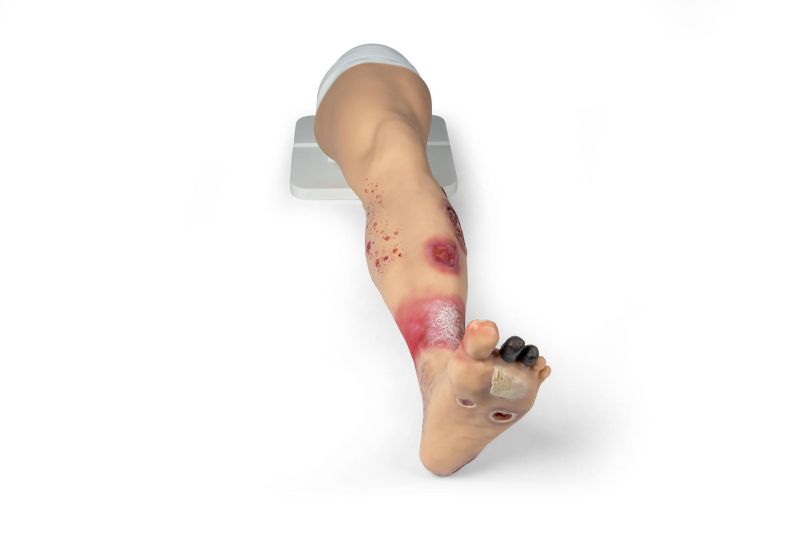 "Lena Leg" - Leg with medical conditions