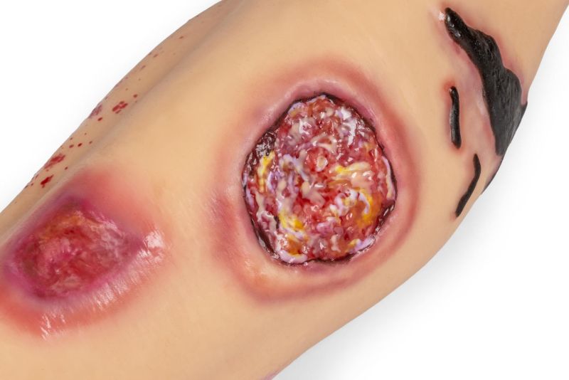 "Lena Leg" - Leg with medical conditions