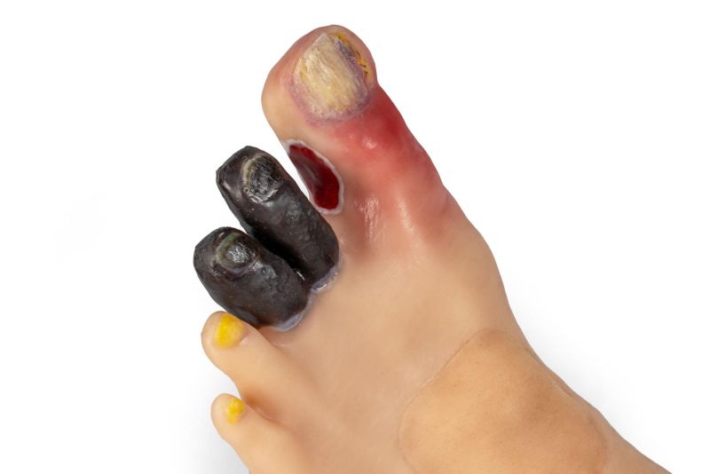 "Lena Leg" - Leg with medical conditions