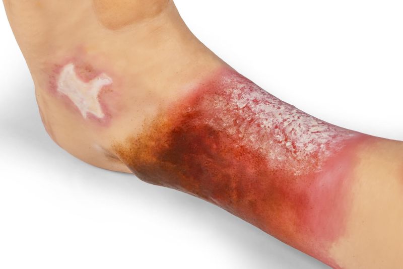 "Lena Leg" - Leg with medical conditions