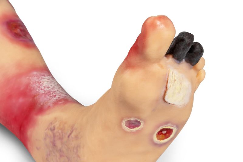 "Lena Leg" - Leg with medical conditions