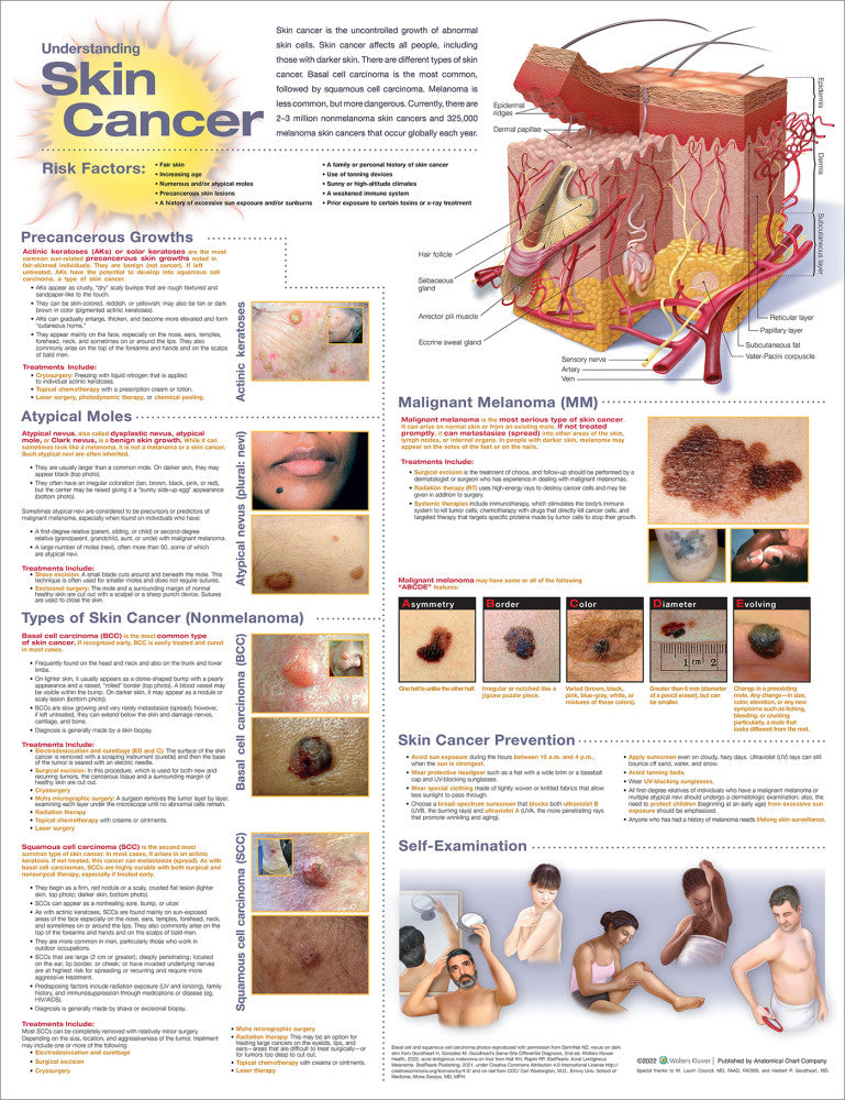 Understanding Skin Cancer Anatomical Chart - 3rd Edition