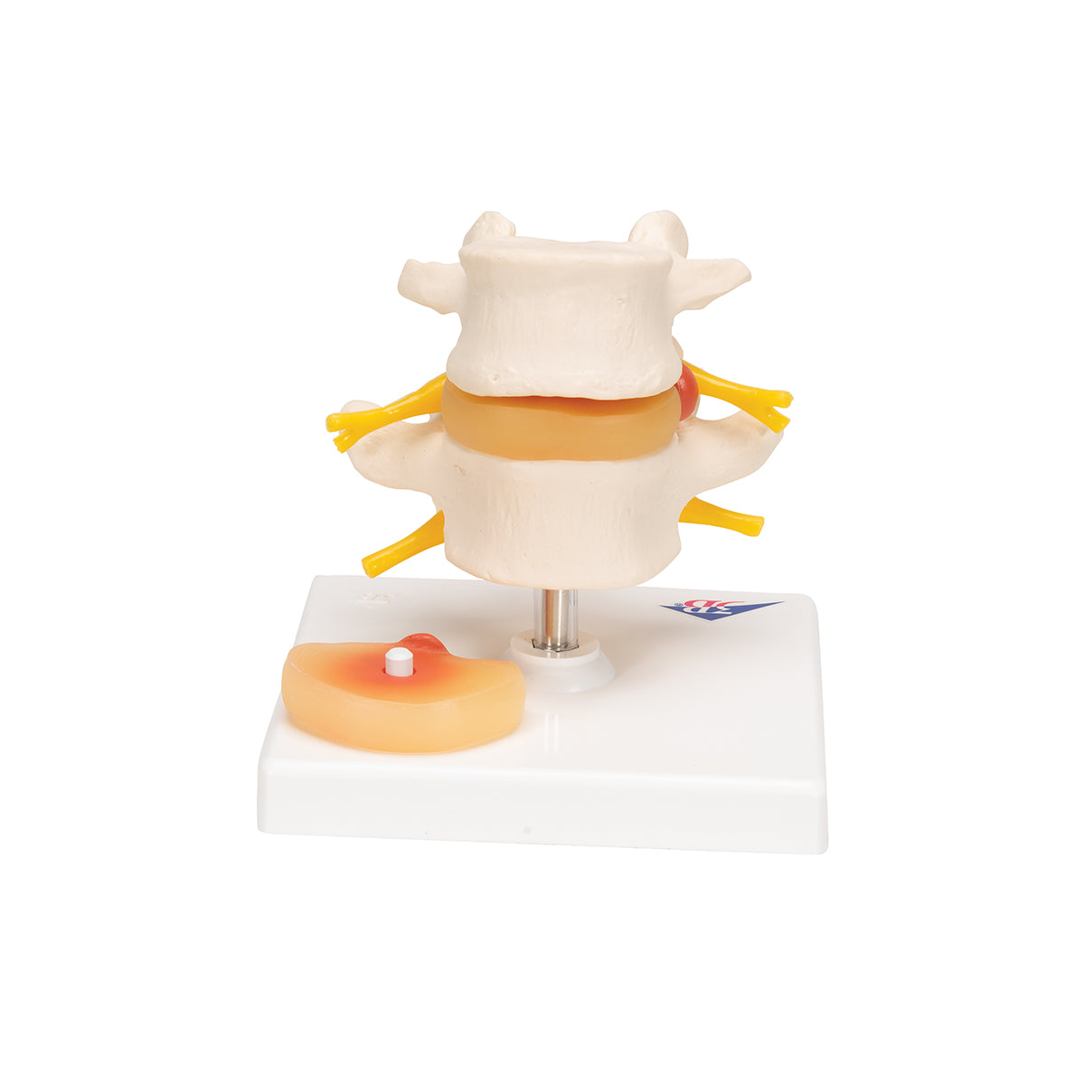 Human Lumbar Spinal Column with Prolapsed Intervertebral Disc - 3B Scientific A76, view 11