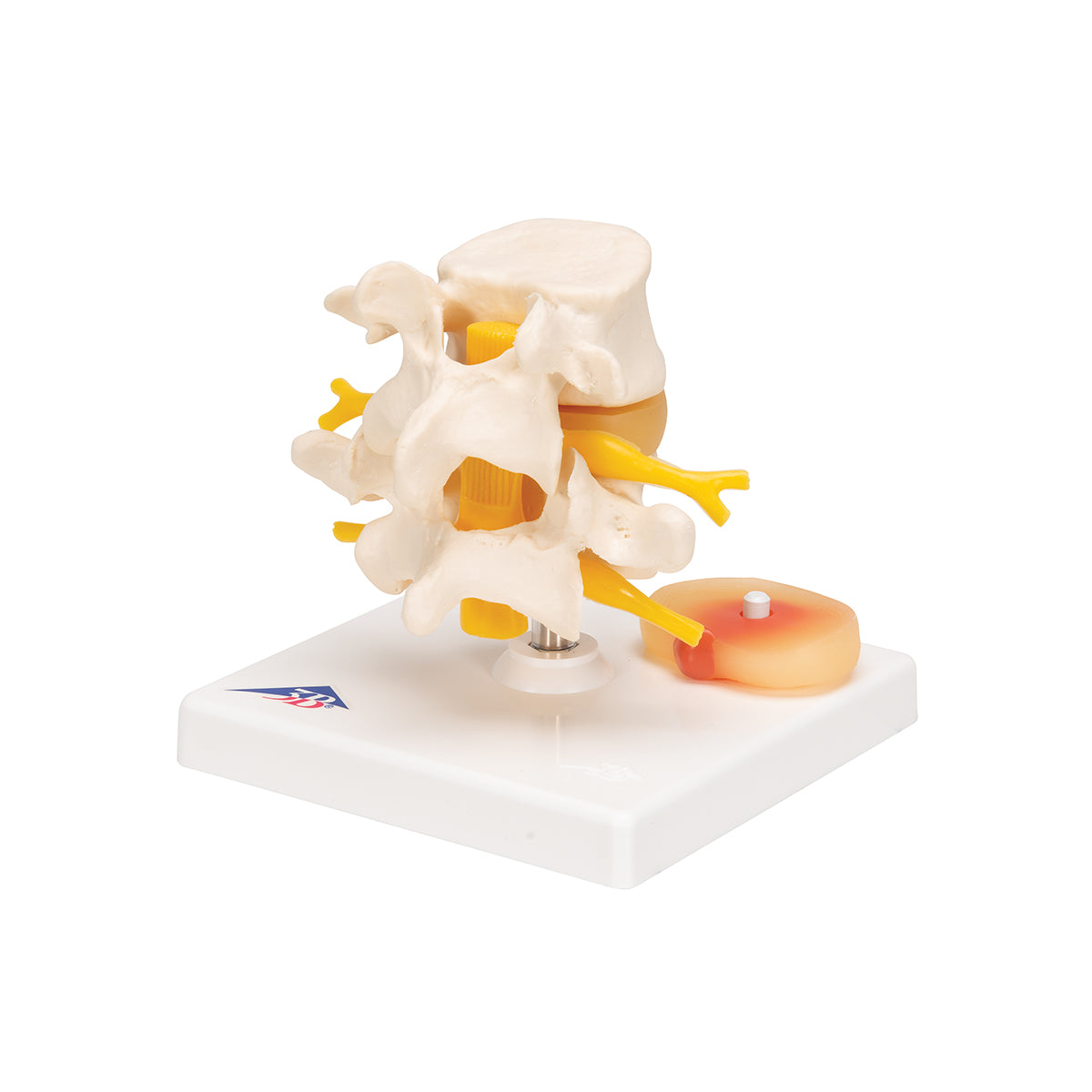 Human Lumbar Spinal Column with Prolapsed Intervertebral Disc - 3B Scientific A76, view 12