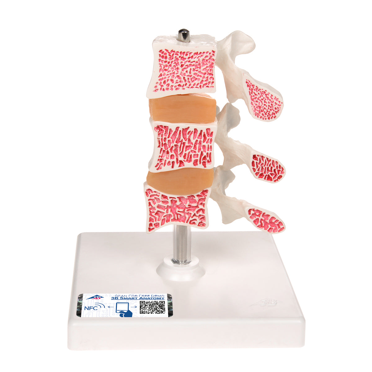 Deluxe Human Osteoporosis Model (3 Vertebrae with Discs), Removable on Stand - 3B Scientific A78, view 6