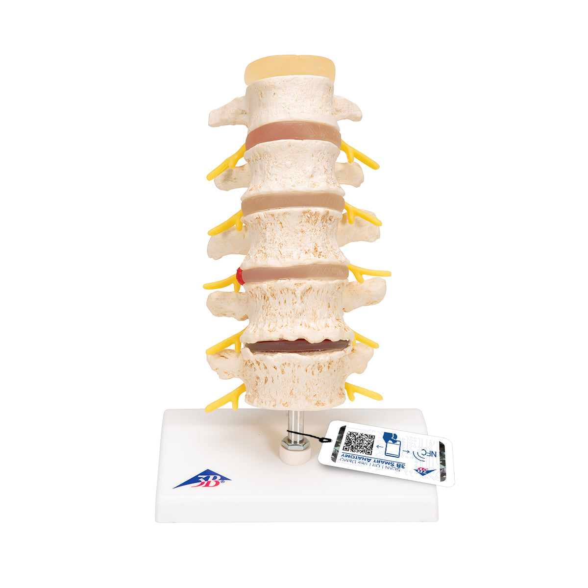 Stages of disc prolapse and vertebral degeneration - 3B Scientific A795, view 8