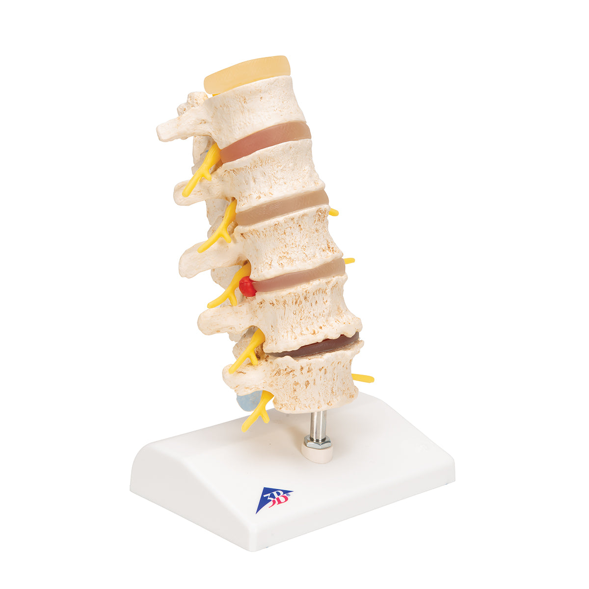 Stages of disc prolapse and vertebral degeneration - 3B Scientific A795, view 2
